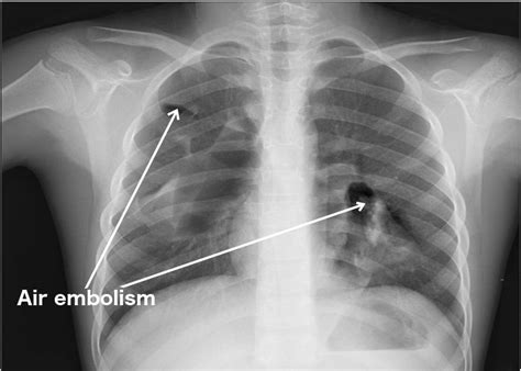 Air embolism,what to know?