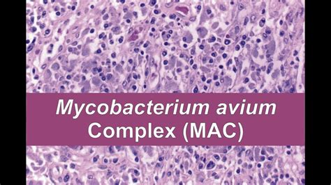 Mycobacterium avium complex; Battey Bacillus; MAIC; Mycobacterium avium ...