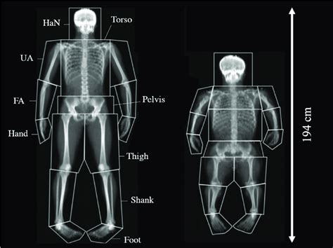 DEXA scans for (left) control and (right) achondroplasia. Segmental ...