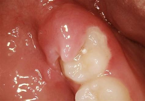 Wisdom Tooth Infection - Symptoms, Causes, Treatment, Pictures