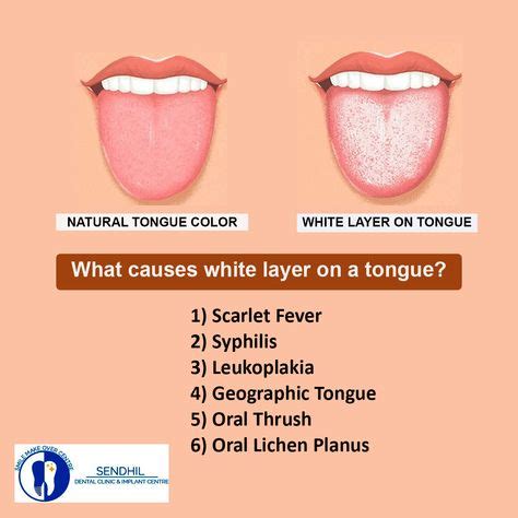 White layer on a tongue is formed by bacteria in the mouth. Poor tongue ...