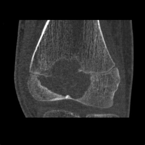 Chondroblastoma - distal femur | Image | Radiopaedia.org