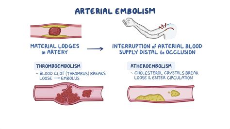 Embolism Meaning