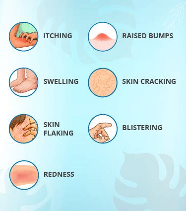 Aggregate more than 72 mehndi allergy symptoms best - seven.edu.vn