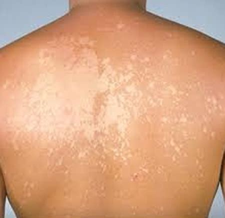 Vitiligo Causes, Symptoms, Treatments, White Spots on SkinMed E Guru