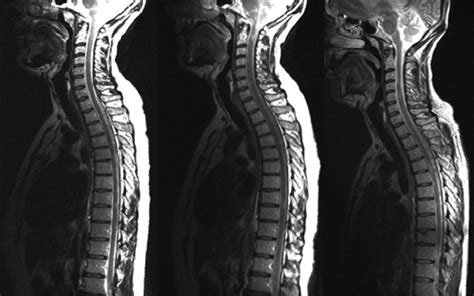 Early MRI scans could predict multiple sclerosis disability | UCL News ...