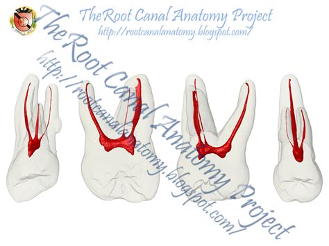 Maxillary 2nd Molar Root Canal Anatomy