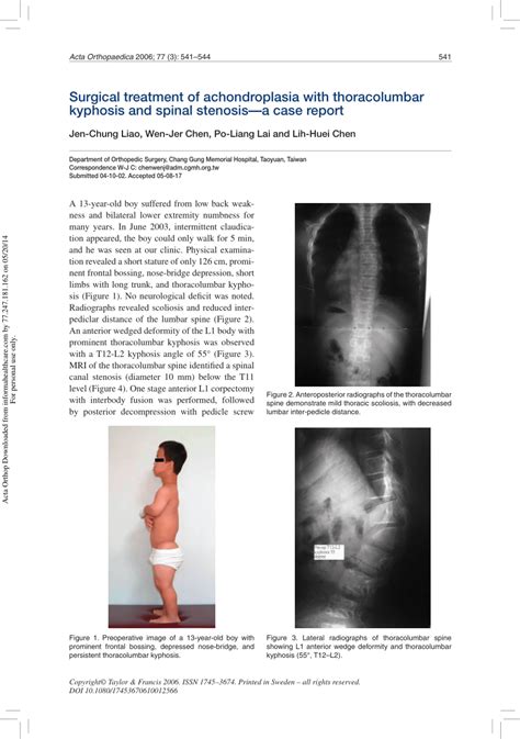 (PDF) Surgical treatment of achondroplasia with thoracolumbar kyphosis ...