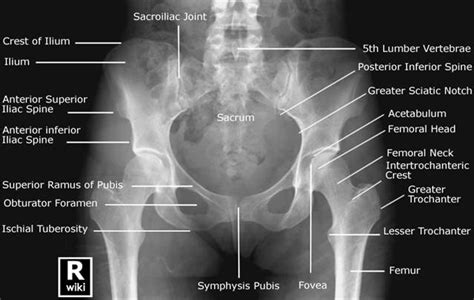 Sacrum Fracture - Fracture Treatment