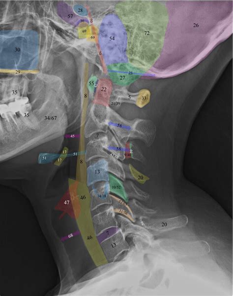 Normal Radiographic Anatomy of the Cervical Spine | Anatomy, Radiology ...