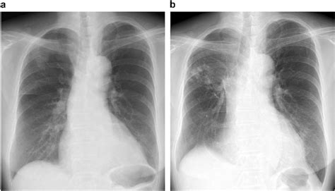 Mycobacterium avium complex lung disease worsening after lung cancer ...