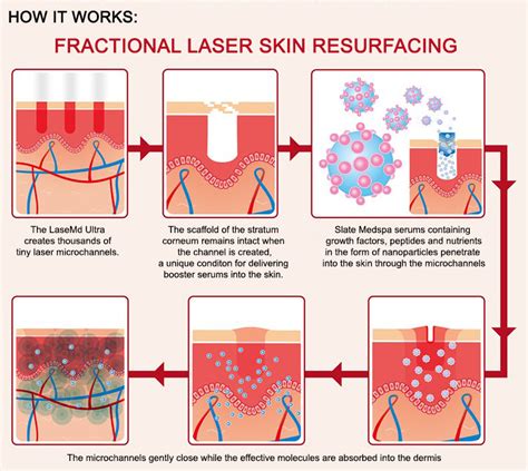 Laser Skin Resurfacing New Jersey | Slate Medspa