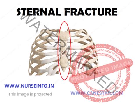 STERNAL FRACTURE - Nurse Info