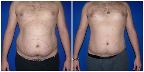 Patient #276 Male Liposuction Before and After Photos Katy - Plastic ...