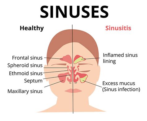 How To Diagnose Sinus Infection - Netwhile Spmsoalan