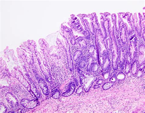 Sessile Polyp Histology