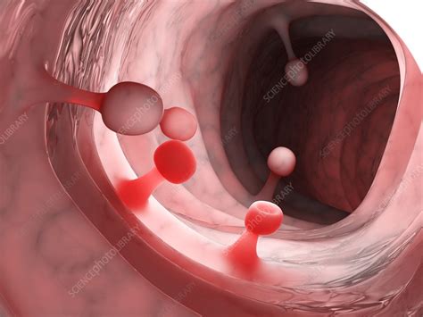 Colon polyps, illustration - Stock Image - F029/5842 - Science Photo ...