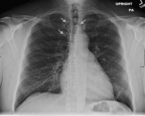 Chest Radiograph Posterior Anterior View Demonstrating Sternal Wire ...