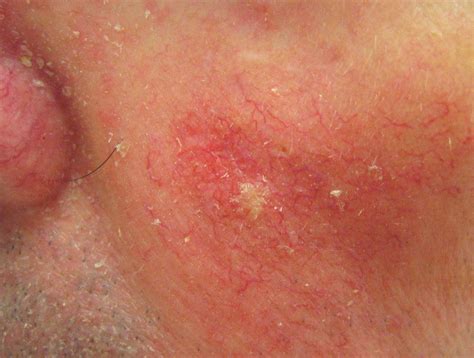 HEALTH FROM TRUSTED SOURCES: Squamous Cell Carcinoma of the Skin