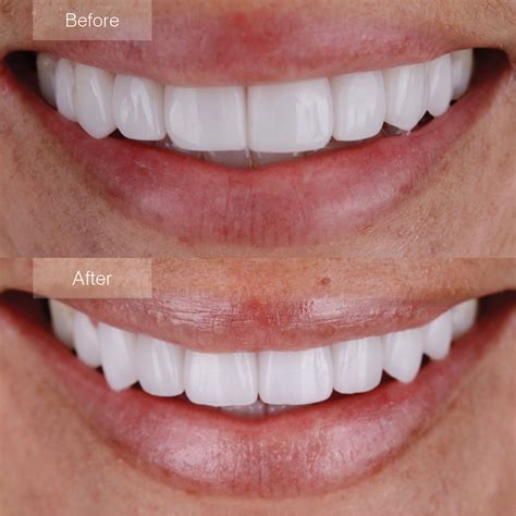 Porcelain Veneers Before and After - The Dental Room