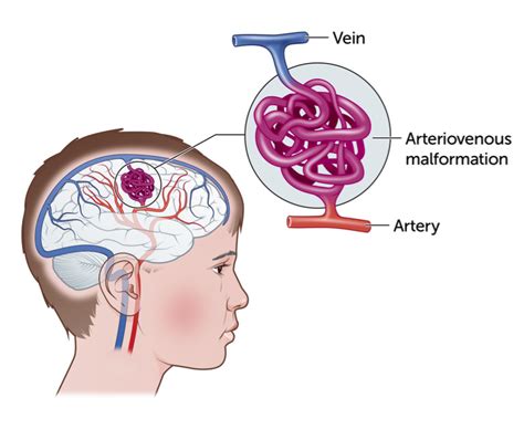 Adenosine as related to Arteriovenous malformation - cerebral - Pictures