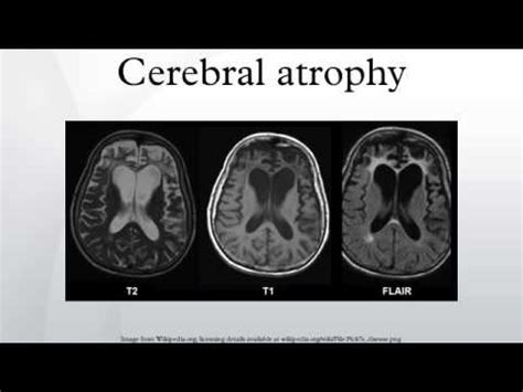 Cerebral atrophy - YouTube