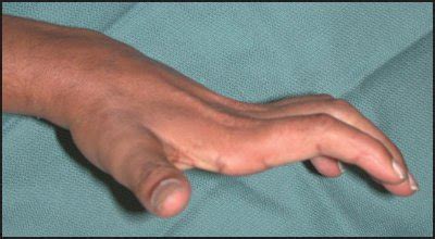 Forearm- and Hand-Based Thumb Orthoses | Musculoskeletal Key