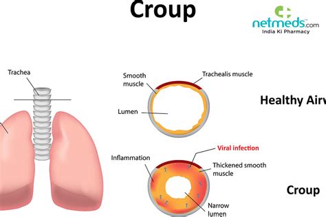 Croup: Causes, Symptoms And Treatment