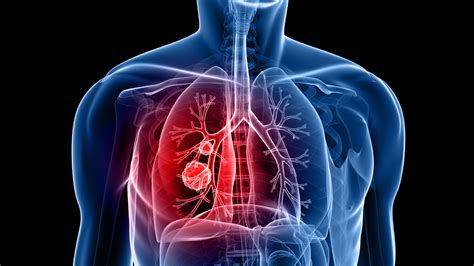 What Does Lung Nodules Mean | OneWelbeck Lung Health