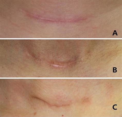 Three types of scars formed after transverse cervical incision for ...