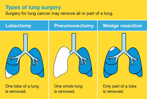 Types Of Lung Cancer Tumors