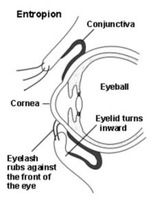 Entropion Surgery - Sunshine Eye Surgeons