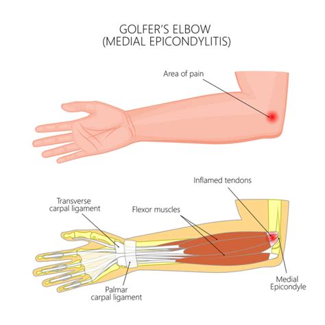 ESWT- Promising results for elbow pain from Golfer's Elbow or Medial ...