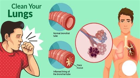 How to Get Rid of Phlegm and Mucus in Chest & Throat (Instant Result ...