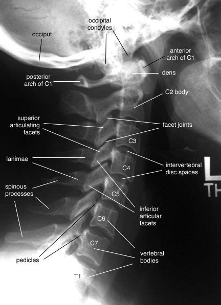 Radiology Anatomy Images : Cervical Spine - Lateral View X-Ray anatomy