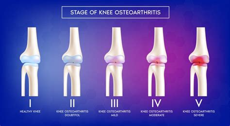 Knee Osteoarthritis - GulfPhysio - UAE's Online Physiotherapy Store