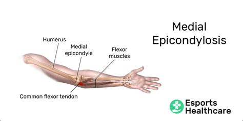 Medial Epicondyle Of Humerus Pain - Lateral Epicondylitis A K A Tennis ...