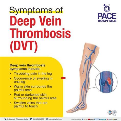 Deep Vein Thrombosis, DVT Symptoms, Causes And, 59% OFF