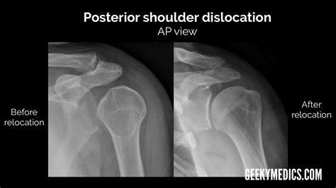 Shoulder X-ray Interpretation | Radiology | Geeky Medics