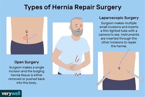 Can You Successfully Treat A Hernia Without Surgery?