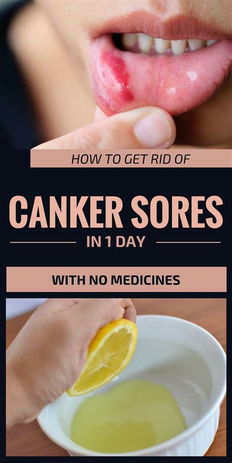 How To Get Rid Of Canker Sores In 1 Day With No Medicines | Canker sore ...