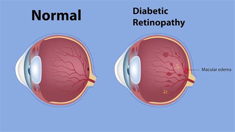 What It’s Like to Have Diabetic Macular Edema | Everyday Health