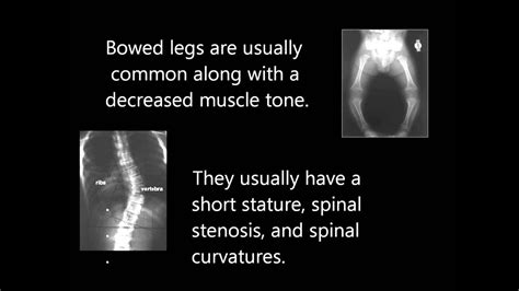 Achondroplasia Genetics Project - YouTube