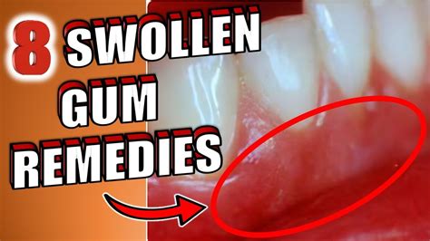 8 Home Remedies To Get Rid of Swollen Gums - YouTube