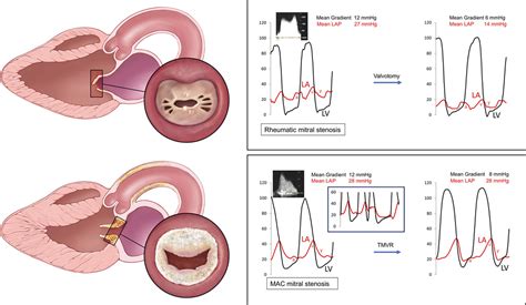 Mitral Stenosis Gradient