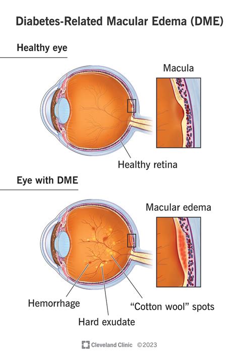 Diabetes-Related Macular Edema (DME): Symptoms & Treatment