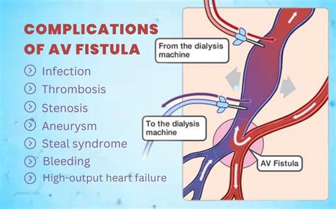 What are complications of AV fistula?