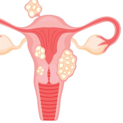 Uterine Fibroids Types