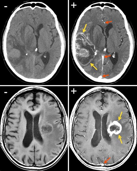 Albums 105+ Pictures Mri Images Of Brain Excellent