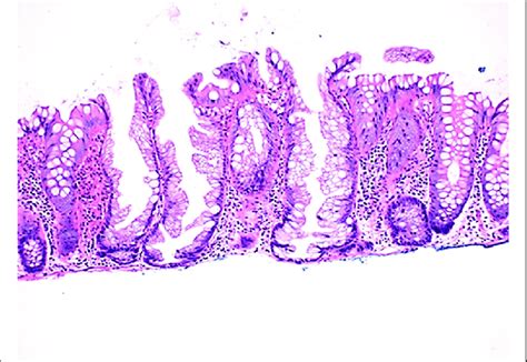 Sessile serrated adenoma. Glands are serrated, branching laterally ...